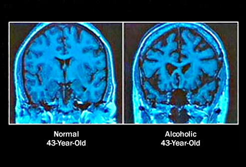wat doet alcohol met je hersenen